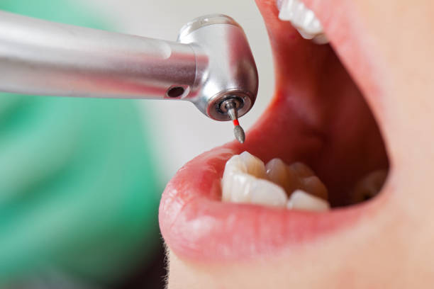 Best Urgent Care for Lost Fillings or Crowns in Celina, OH